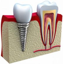 کلینیک تخصصی دندان پزشکی مرزداران ارتودنسی جرم گیری عصب کشی ایمپلنت